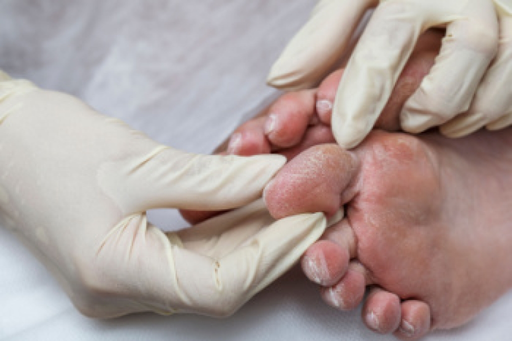 Managing Diabetic Foot Complications With Early Podiatric Care