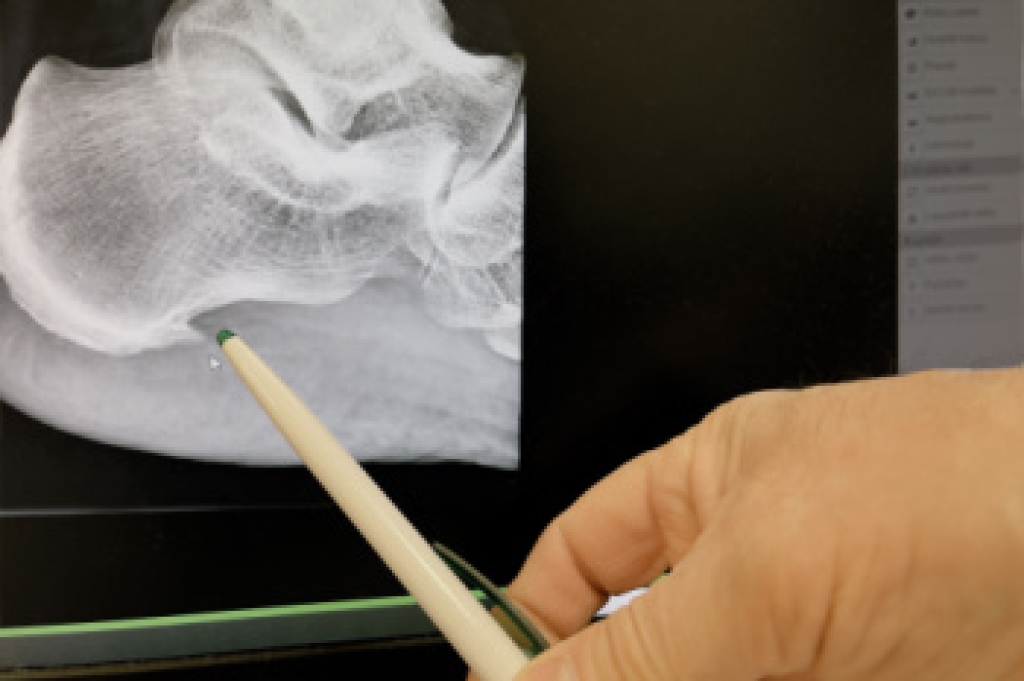 Types of Heel Spurs