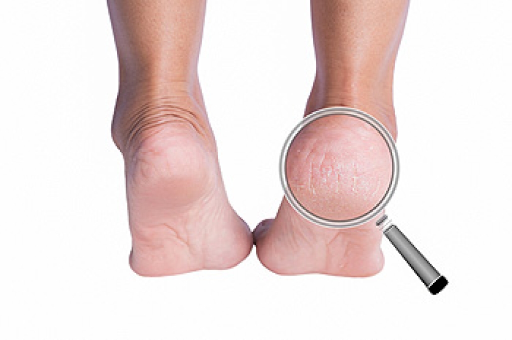 How Podiatrists Treat Painful Cracked Heels