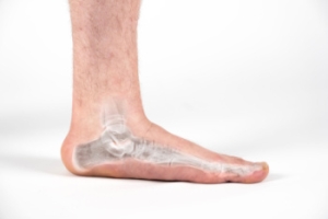 Flat Feet Are Known as Fallen Arches