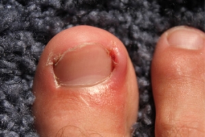 Why do Ingrown Toenails Develop?