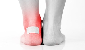 Tips on Avoiding Blisters this Summer
