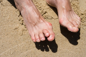 What Are the Symptoms of Hammertoe?