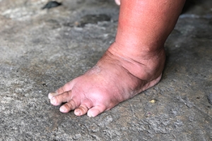 Swollen Feet May Be a Sign of Diabetes