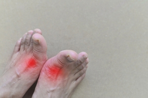 Recognizing Complications From Gout