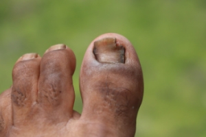 Toenail Fungus in Older Adults