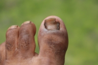 Toenail Fungus in Older Adults