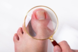 Relief from Painful Ingrown Toenails