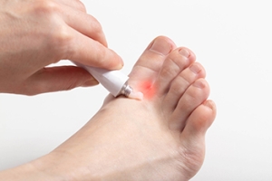 Athlete’s Foot Explained