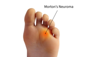 A Podiatrist's Role in Treating Morton’s Neuroma