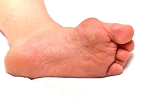 Causes of Bunions