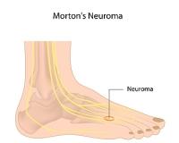 Painful Nerves in the Foot