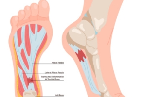 What Does Plantar Fasciitis Feel Like?