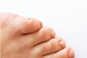 Painful Pinky Toe Corns